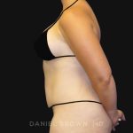 Tummy Tuck Before & After Patient #10788