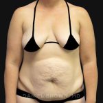 Tummy Tuck Before & After Patient #10788