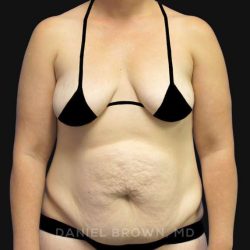 Tummy Tuck Before & After Patient #10788