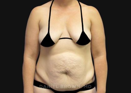 Tummy Tuck Before & After Patient #10788