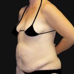 Tummy Tuck Before & After Patient #10788