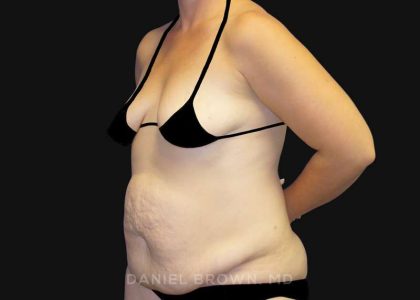 Tummy Tuck Before & After Patient #10788