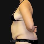 Tummy Tuck Before & After Patient #10788