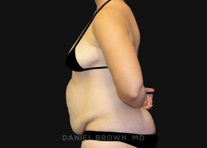 Tummy Tuck Before & After Patient #10788