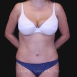 Tummy Tuck Before & After Patient #10801