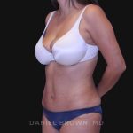 Tummy Tuck Before & After Patient #10801