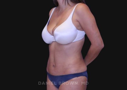 Tummy Tuck Before & After Patient #10801