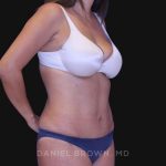 Tummy Tuck Before & After Patient #10801
