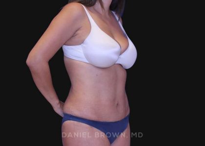Tummy Tuck Before & After Patient #10801