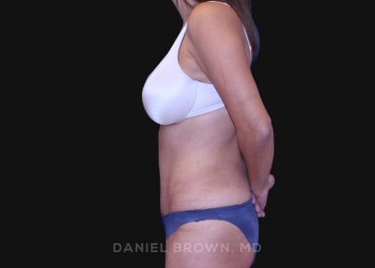 Tummy Tuck Before & After Patient #10801