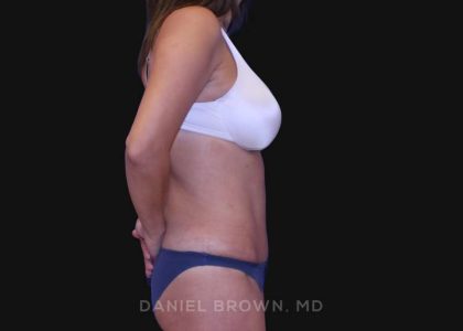 Tummy Tuck Before & After Patient #10801