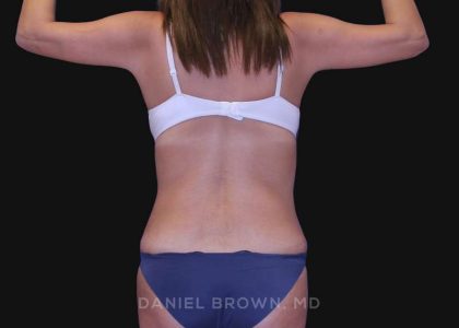 Tummy Tuck Before & After Patient #10801