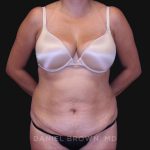 Tummy Tuck Before & After Patient #10801