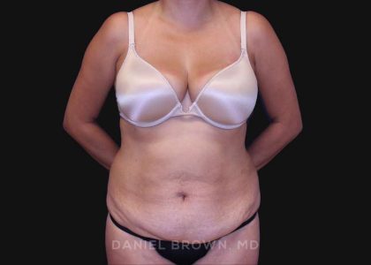 Tummy Tuck Before & After Patient #10801
