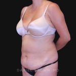 Tummy Tuck Before & After Patient #10801