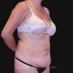 Tummy Tuck Before & After Patient #10801