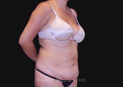Tummy Tuck Before & After Patient #10801