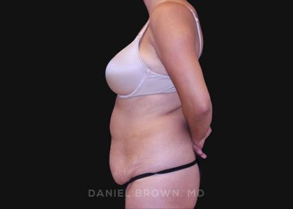 Tummy Tuck Before & After Patient #10801