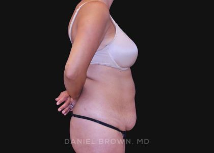 Tummy Tuck Before & After Patient #10801