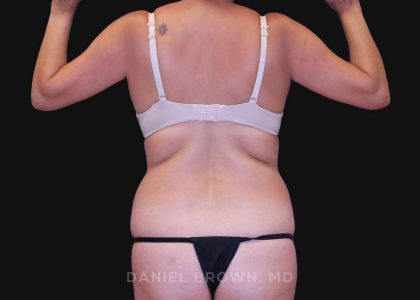 Tummy Tuck Before & After Patient #10801