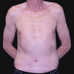 Tummy Tuck Before & After Patient #10812
