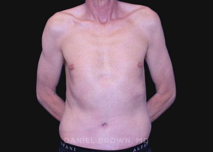 Tummy Tuck Before & After Patient #10812