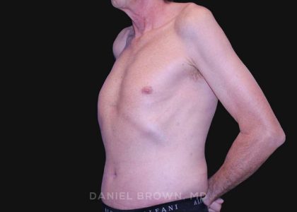 Tummy Tuck Before & After Patient #10812