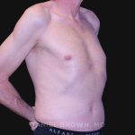 Tummy Tuck Before & After Patient #10812