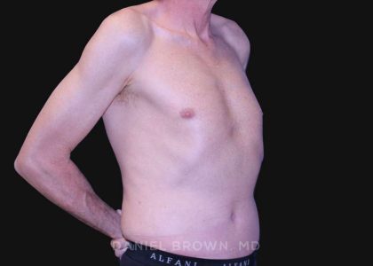 Tummy Tuck Before & After Patient #10812