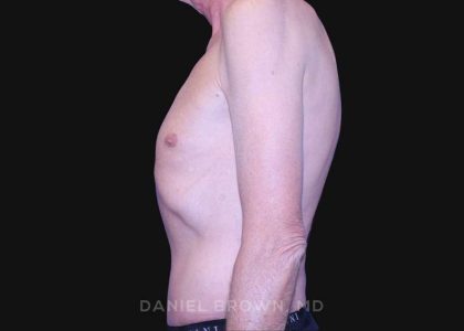 Tummy Tuck Before & After Patient #10812