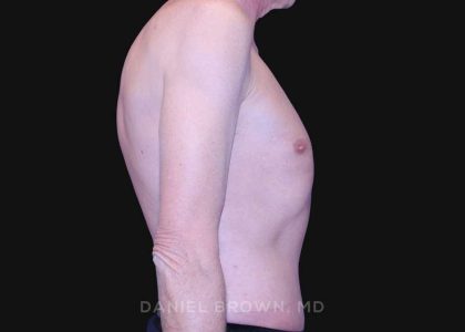 Tummy Tuck Before & After Patient #10812