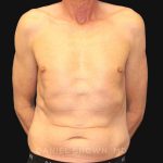 Tummy Tuck Before & After Patient #10812