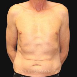 Tummy Tuck Before & After Patient #10812