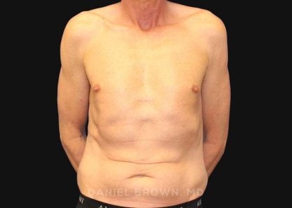 Tummy Tuck Before & After Patient #10812