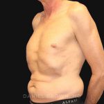 Tummy Tuck Before & After Patient #10812