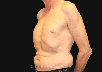Tummy Tuck Before & After Patient #10812
