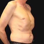 Tummy Tuck Before & After Patient #10812