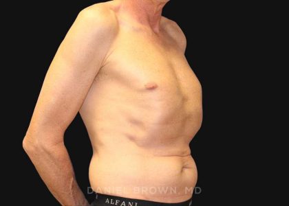 Tummy Tuck Before & After Patient #10812