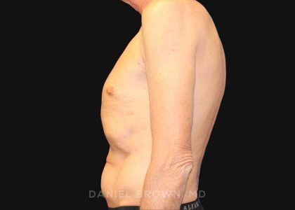Tummy Tuck Before & After Patient #10812