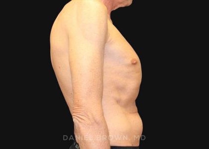 Tummy Tuck Before & After Patient #10812