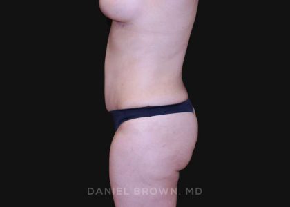 Tummy Tuck Before & After Patient #10825
