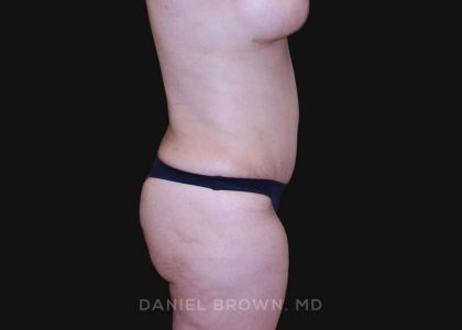 Tummy Tuck Before & After Patient #10825