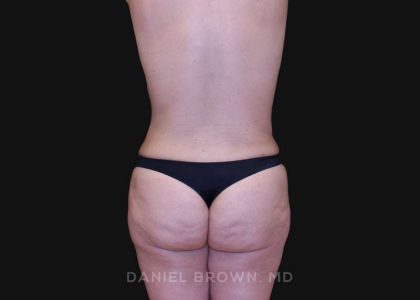 Tummy Tuck Before & After Patient #10825