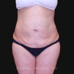 Tummy Tuck Before & After Patient #10825