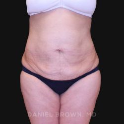 Tummy Tuck Before & After Patient #10825