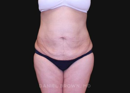 Tummy Tuck Before & After Patient #10825