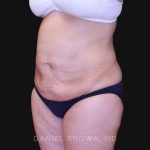 Tummy Tuck Before & After Patient #10825