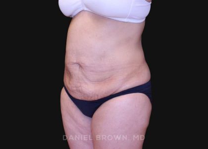 Tummy Tuck Before & After Patient #10825