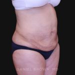 Tummy Tuck Before & After Patient #10825
