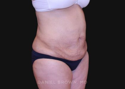Tummy Tuck Before & After Patient #10825